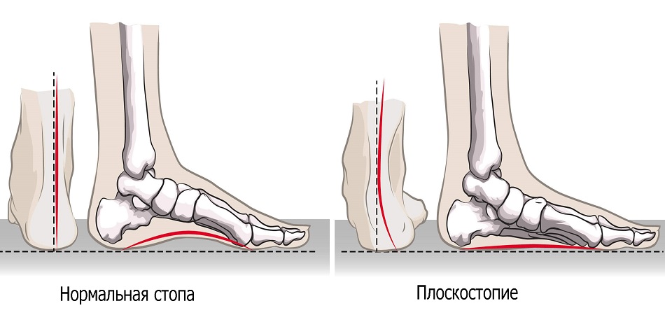 Изменения при плоскостопии Изменения при плоскостопии