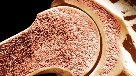 Улучшение структуры кости