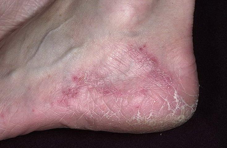 Побочный эффект от Димексида Побочный эффект от Димексида