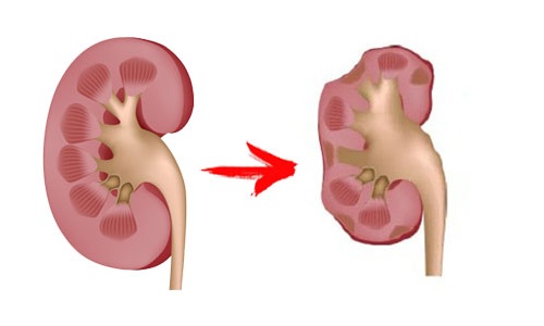 Почечная недостаточность Почечная недостаточность