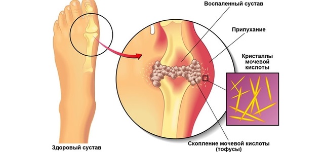 Изменения при подагре Изменения при подагре