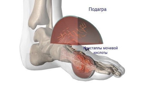Подагра Подагра