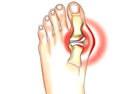 Подагра Подагра