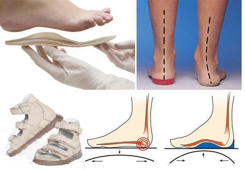 Подбор ортопедической обуви при плоско-вальгусной стопе Подбор ортопедической обуви при плоско-вальгусной стопе
