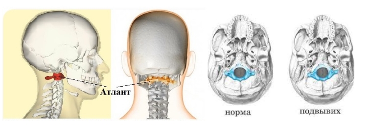 Подвывих атланта Подвывих атланта