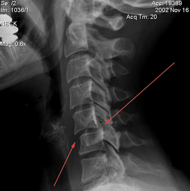 Подвывих атланта на рентген снимке Подвывих атланта на рентген снимке