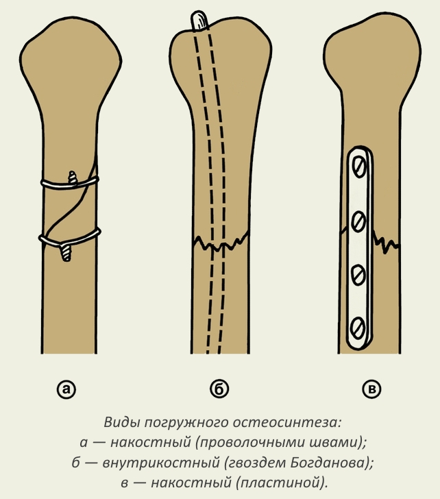 Виды погружного остеосинтеза