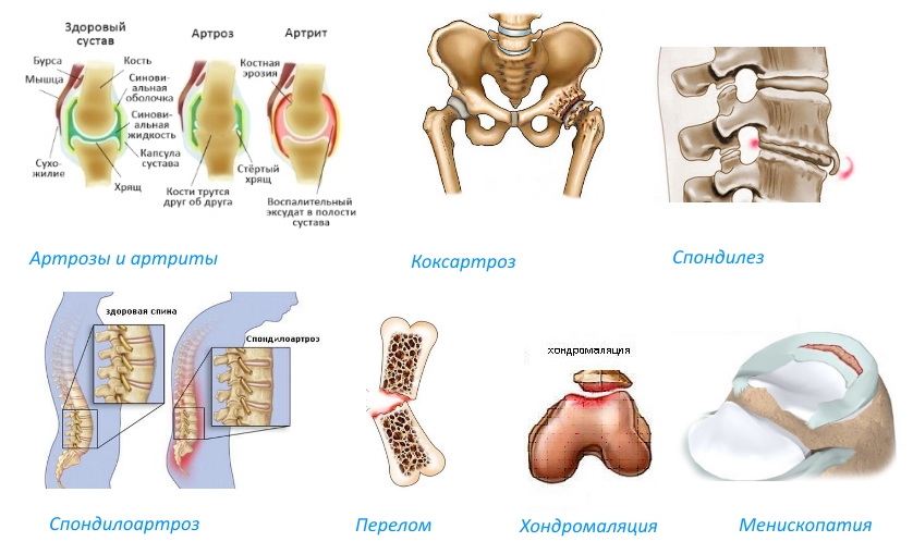 Показания для Биартрина Показания для Биартрина