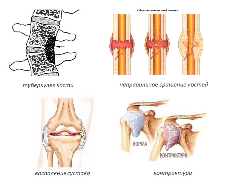 Показания для артролиза Показания для артролиза