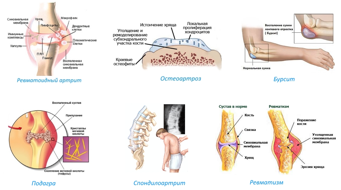 Показания для Артрозилена Показания для Артрозилена