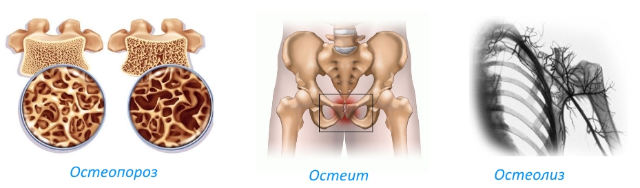 Показания для приема препарата Миакальцик Показания для приема препарата Миакальцик