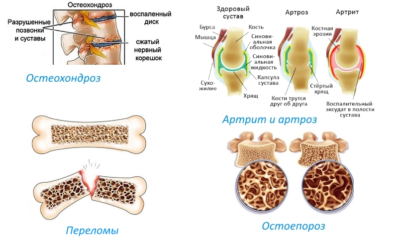 Показания для приема Хондроитина Показания для приема Хондроитина