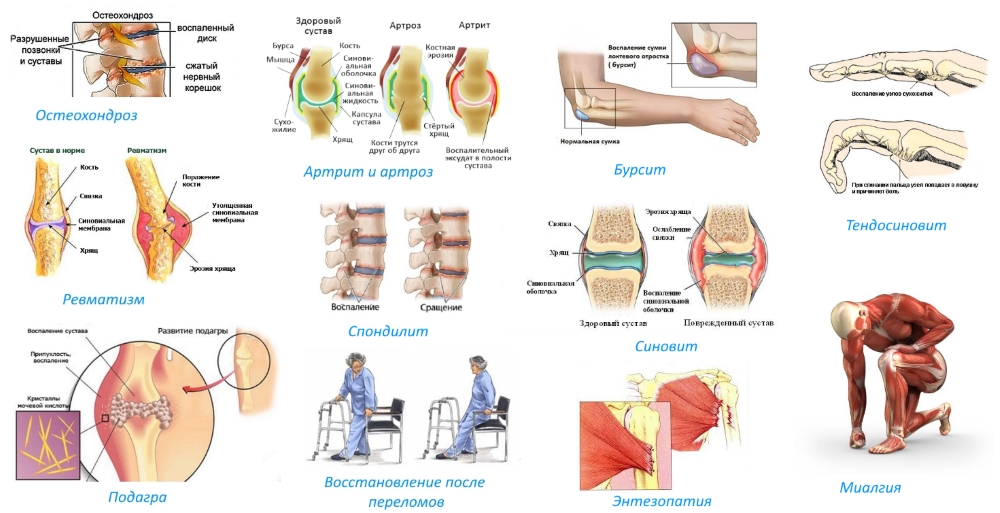 Показания для приема Артрозилена Показания для приема Артрозилена