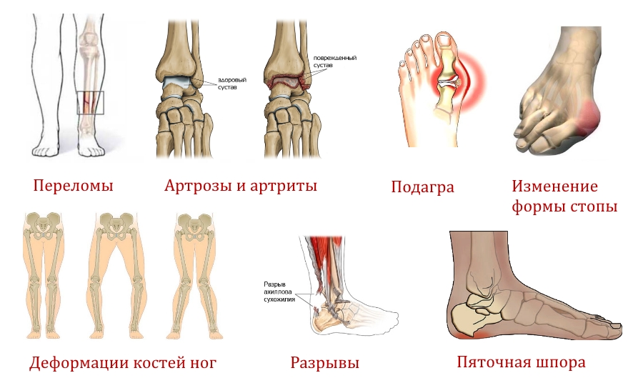 Показания для рентгена ног Показания для рентгена ног