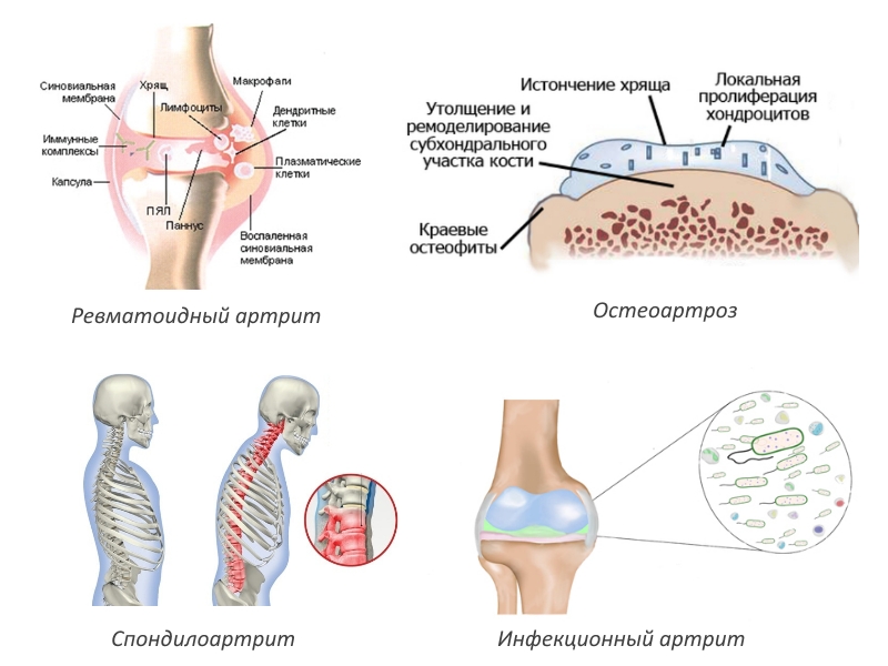 Показания для введения Амелотекса Показания для введения Амелотекса