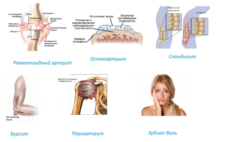Показания к Ацеклофенаку Показания к Ацеклофенаку