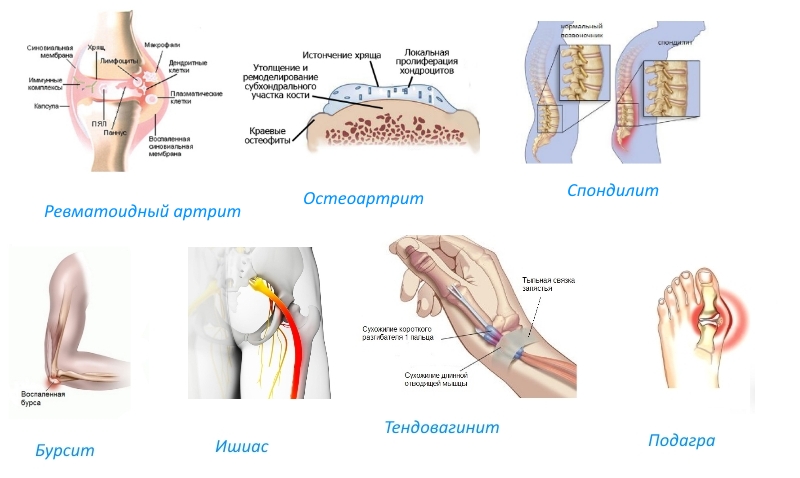 Показания к приему Артроксана Показания к приему Артроксана