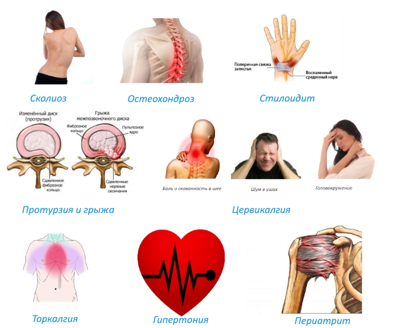 Показания к мануальной терапии Показания к мануальной терапии