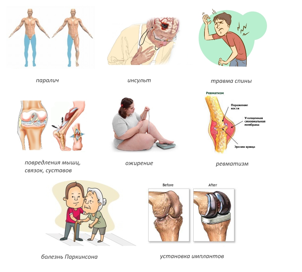 Показания к механотерапии Показания к механотерапии