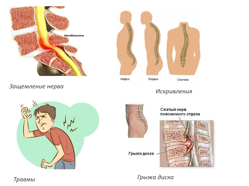 Показания к вытяжению позвоночника Показания к вытяжению позвоночника