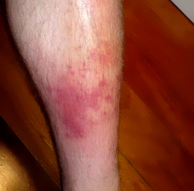 Покраснение и отек ног Покраснение и отек ног