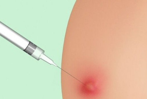 Покраснение и отек после укола Покраснение и отек после укола