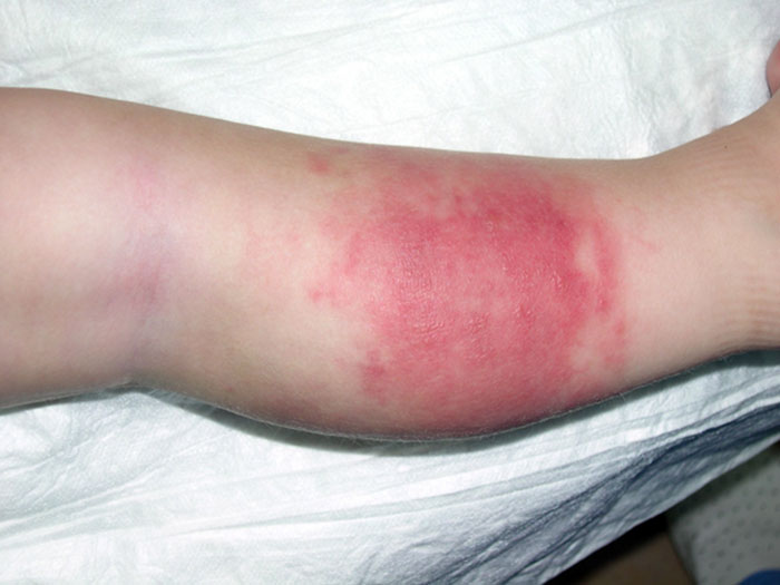 Покраснение при остите Покраснение при остите