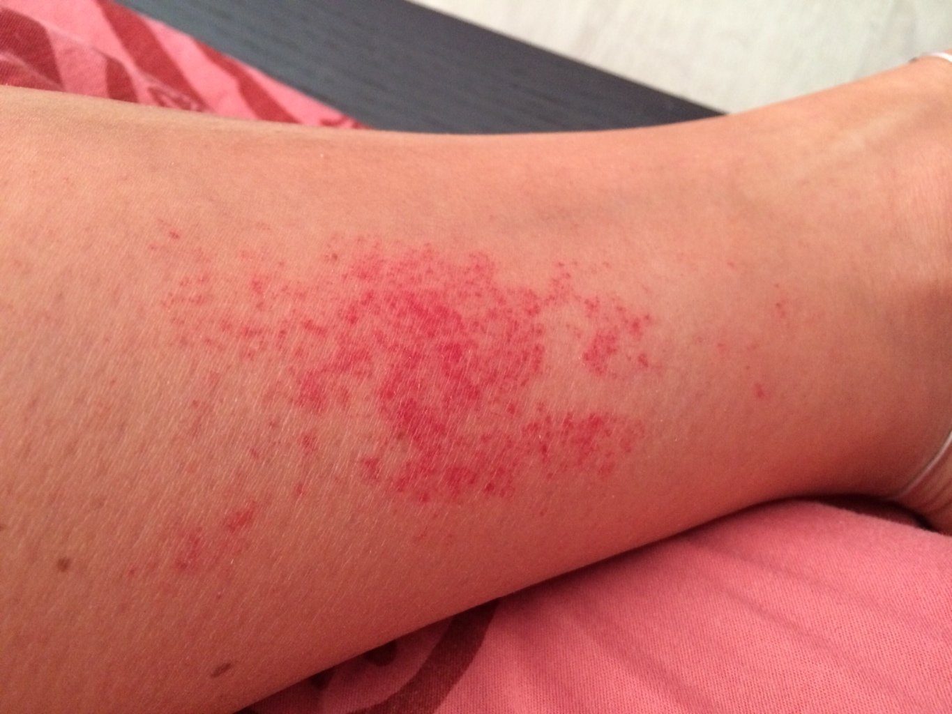 Покраснение, зуд и жжение