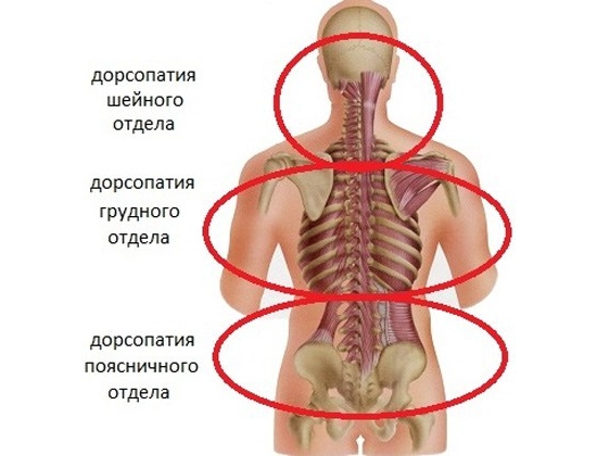 Полисегментарная дорсопатия Полисегментарная дорсопатия