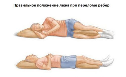 Положение лежа при переломе ребер