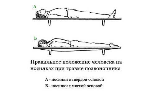 Положение на носилках при ушибе позвоночника Положение на носилках при ушибе позвоночника