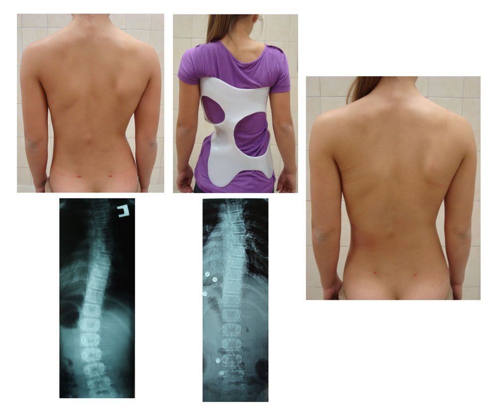 Польза корректора Шено Польза корректора Шено