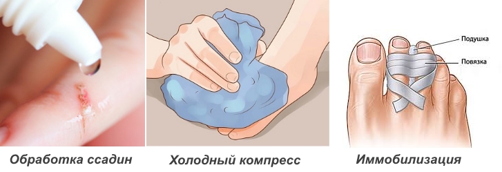 Первая помощь при ушибе пальца на ноге Первая помощь при ушибе пальца на ноге