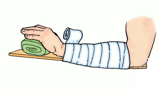 Первая помощь при вывихе кисти Первая помощь при вывихе кисти