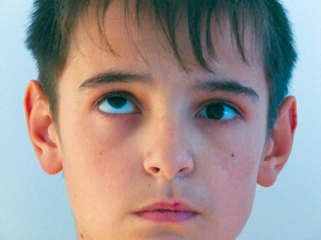 Последствие перелома глаза Последствие перелома глаза