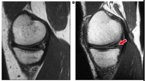 Повреждение мениска на МРТ снимке Повреждение мениска на МРТ снимке
