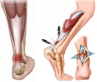 Повреждение сухожилий голени Повреждение сухожилий голени