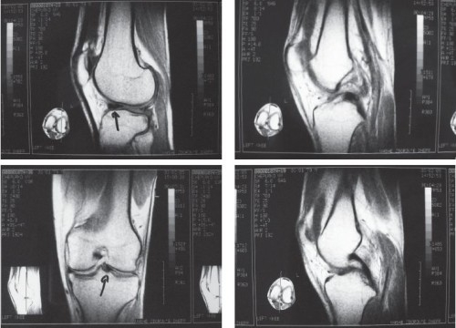 Повреждение связки колена на МРТ Повреждение связки колена на МРТ