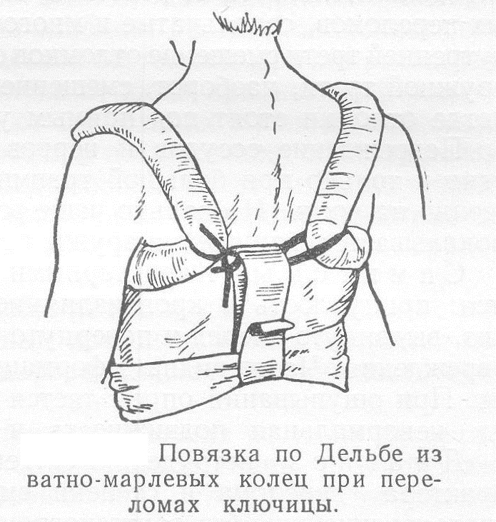 Перевязка Дельбе Перевязка Дельбе