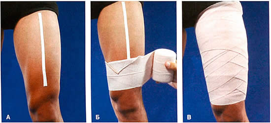 Повязка на бедро при растяжении Повязка на бедро при растяжении