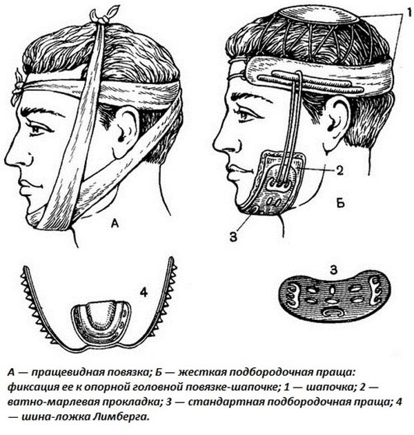 Повязки при переломе челюсти Повязки при переломе челюсти