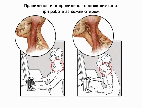 Правильное положение шеи за компьютером Правильное положение шеи за компьютером