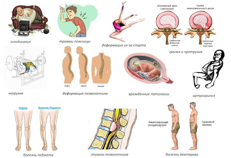 Частые причины спондилолистеза Частые причины спондилолистеза