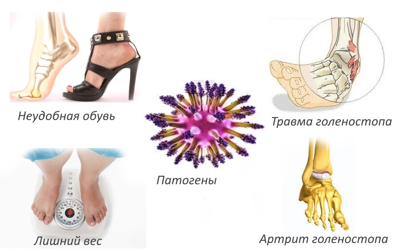 Причины ахиллобурсита Причины ахиллобурсита