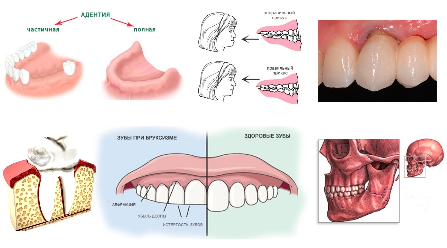 Причины артроза челюсти Причины артроза челюсти