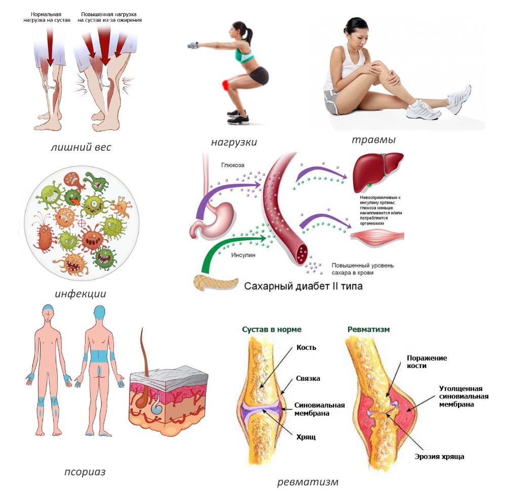 Причины бурсита Причины бурсита