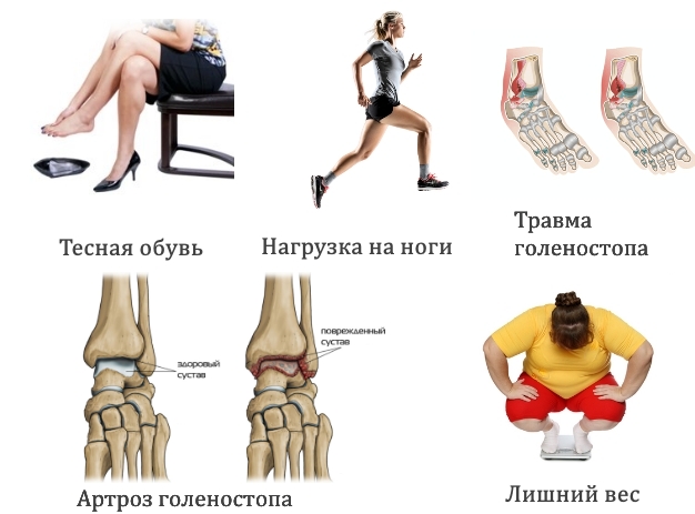 Частые причины гигромы голеностопа Частые причины гигромы голеностопа