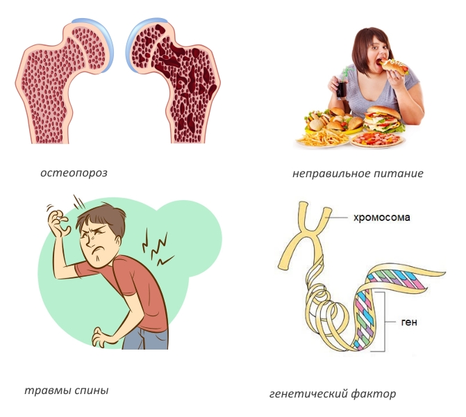 Частые причины кифоза Шейермана Мау Частые причины кифоза Шейермана Мау