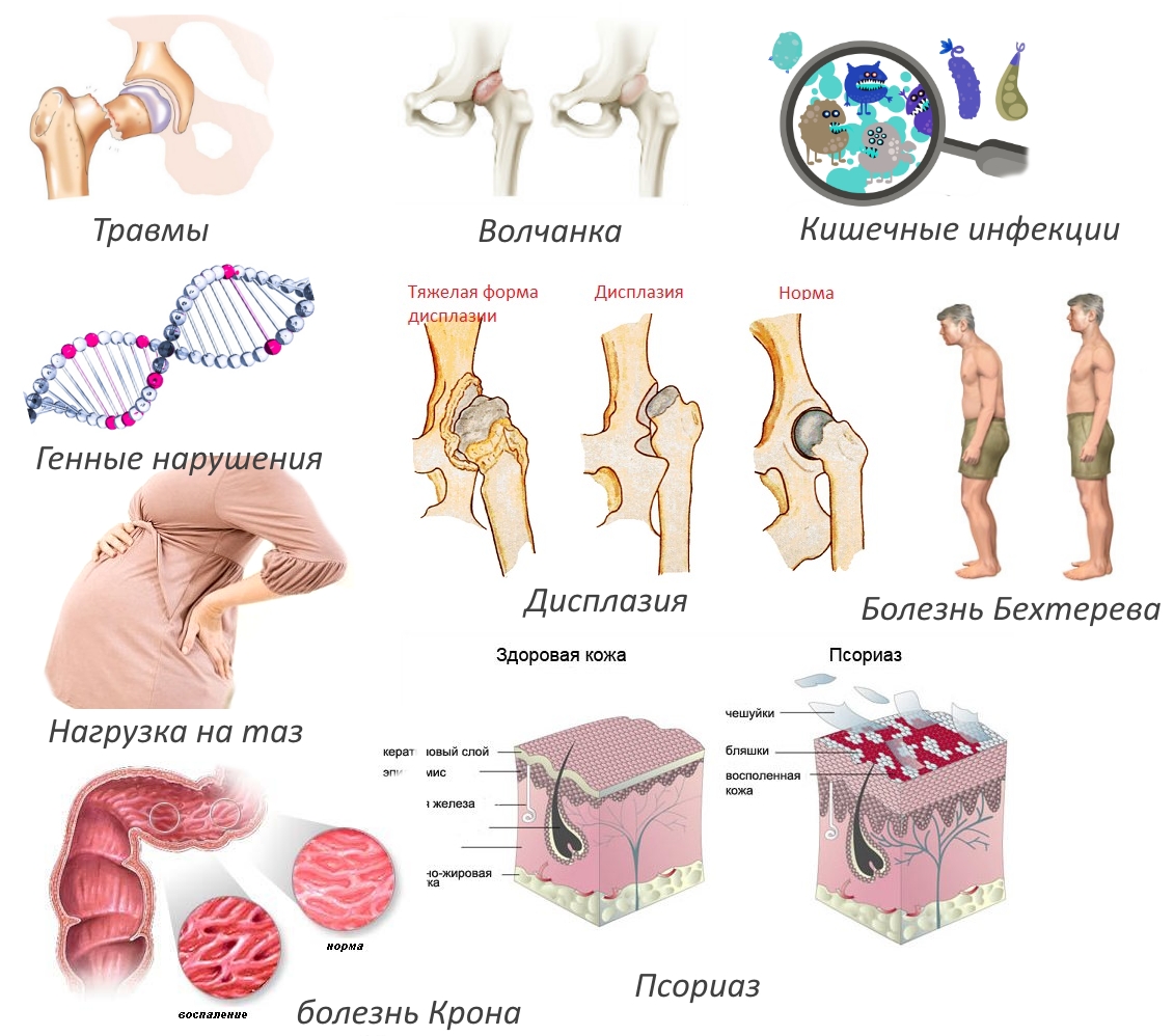 Причины коксартрита Причины коксартрита