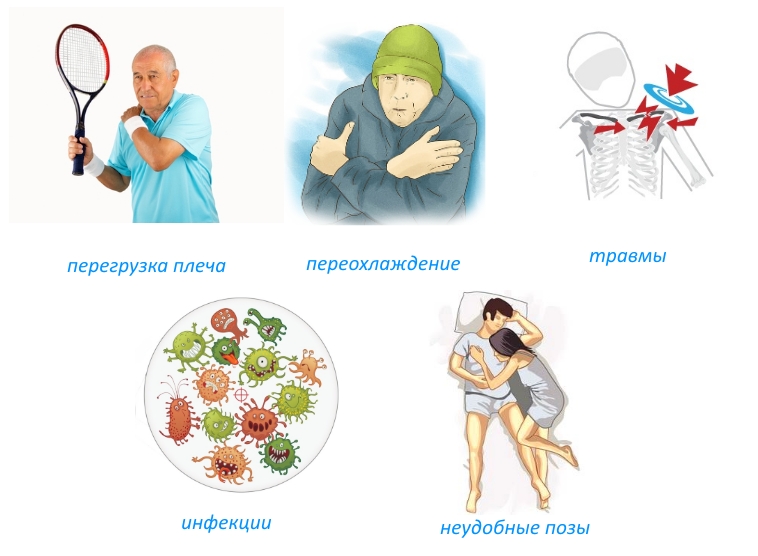 Причины миозита плеча Причины миозита плеча